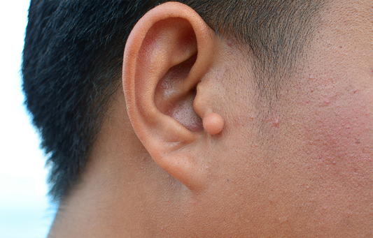 man's side view of ear with keloid