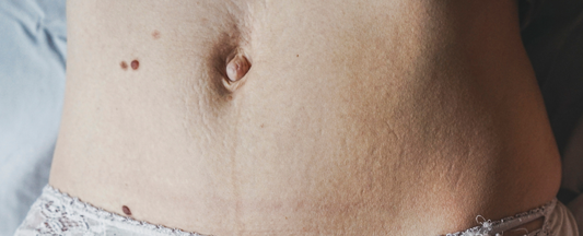 outie navel
